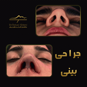 جراحی-بینی-مازندران-16