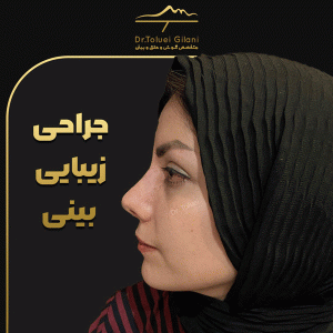 جراحی-بینی-مازندران-18