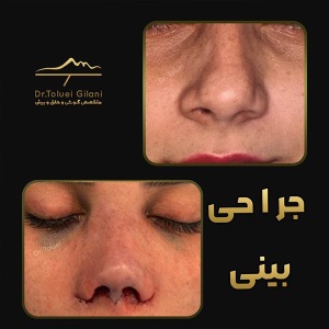 جراحی-بینی-مازندران-21