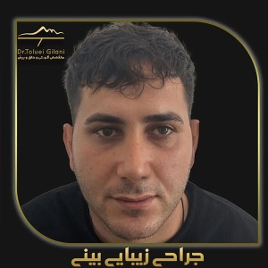 جراحی-بینی-مازندران-24