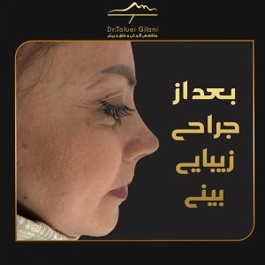 جراحی-بینی-مازندران-26