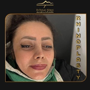 جراحی-بینی-مازندران-27