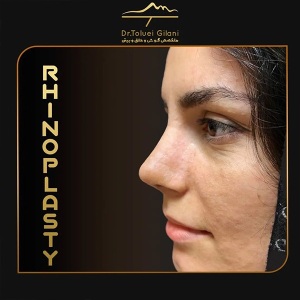 جراحی-بینی-مازندران-37