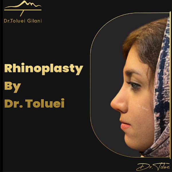 عکس رینوپلاستی بینی استخوانی - دکتر محمود حسین طلوعی-drtoluei.com