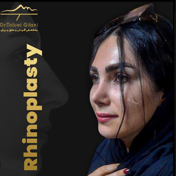 عکس عمل بینی استخوانی - دکتر محمود حسین طلوعی-/drtoluei.com