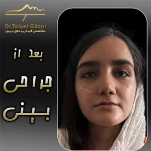 عکس رینوپلاستی بینی گوشتی - دکتر طلوعی - drtoluei.com