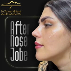 عکس عمل کردن بینی طبیعی - دکتر طلوعی گیلانی -drtoluei.com