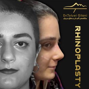عکس عمل بینی گوشتی - دکتر محمود حسین طلوعی - drtoluei.com