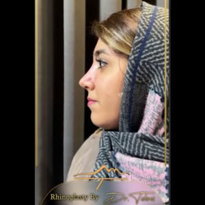 عکس عمل بینی نچرال - دکتر طلوعی - drtoluei.com