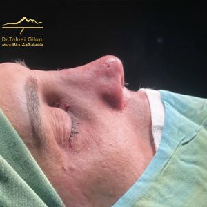 عکس عمل ترمیمی بینی - دکتر طلوعی - drtoluei.com