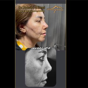 عکس جراحی ترمیمی بینی - دکتر طلوعی - drtoluei.com