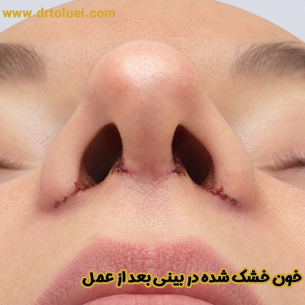 خون خشک شده در بینی بعد از عمل